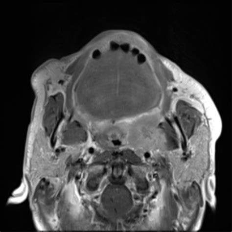Palatine Tonsil Squamous Cell Carcinoma Image