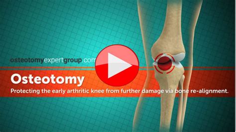 Osteotomy Animation02 1280x720 Knee Preservation Foundation