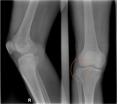 Segond Fracture Of The Proximal Tibia Sumers Radiology Blog
