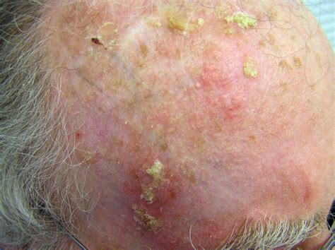 A Keratosis Dorothee Padraig South West Skin Health Care