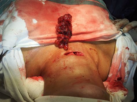 General Surgery Clinics A Surgeon S Blog Minimally Invasive Thyroidectomy