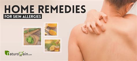 7 Home Remedies For Hives To Stop Itching Naturally At Home