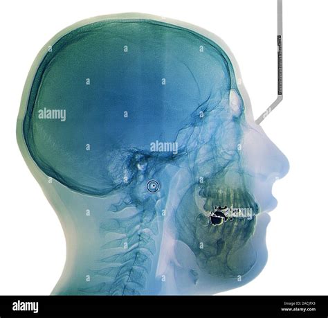 Coloured X Ray Side View Of The Skull In An 18 Year Old Patient With