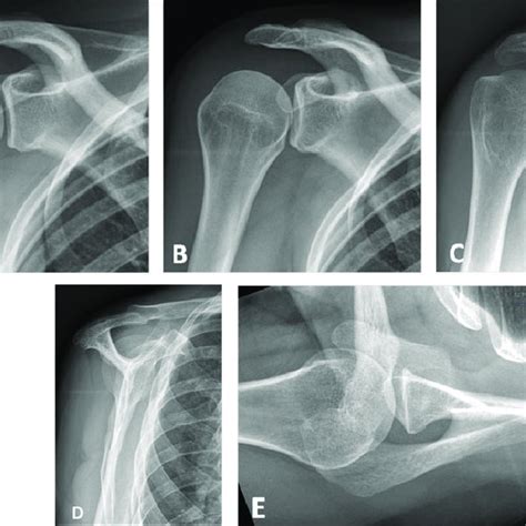 Subchondral Cysts Of The Humeral Head And Normal Bare Area A Axial Download Scientific