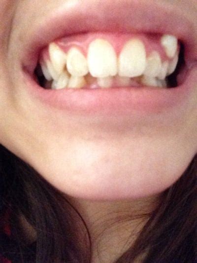 What Do I Do With My Exposed Canine Tooth Which Is Above My Baby Tooth