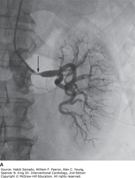 Renal Artery Angioplasty And Stenting Thoracic Key