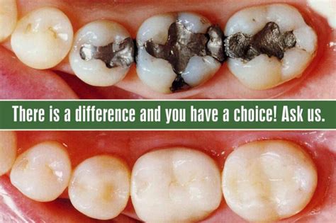 Dental Restorations Amalgam Vs Resin Composite Which One Is Right For