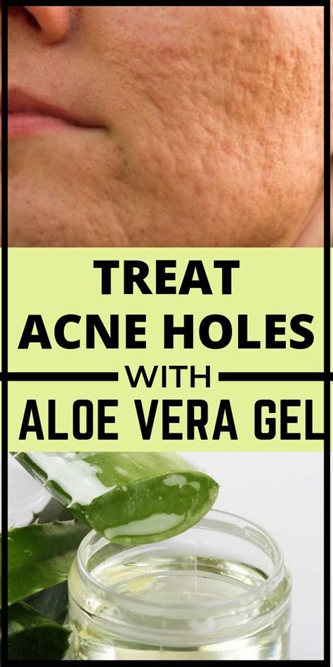 Natural Remedies To Treat Acne Holes At Home Acne Acnetreatments