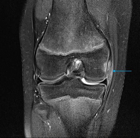 Anatomy Of Knee Mri How To Read Your Knee Mri By Dr Chris Centano