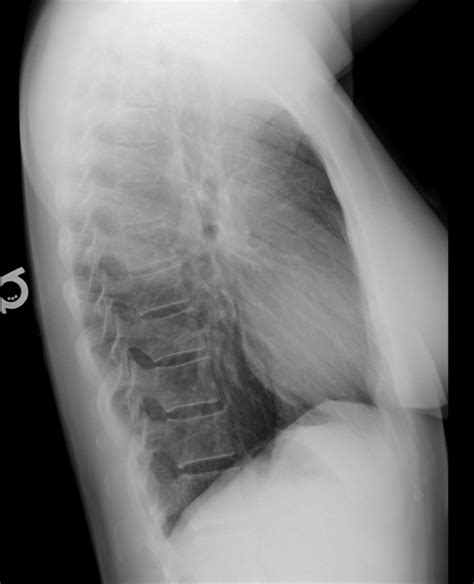 Lateral Chest Radiograph Diagram Quizlet