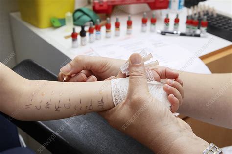 Allergy Test Child Stock Image C0170168 Science Photo Library