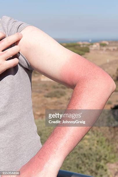 Red Rash Arm Photos And Premium High Res Pictures Getty Images