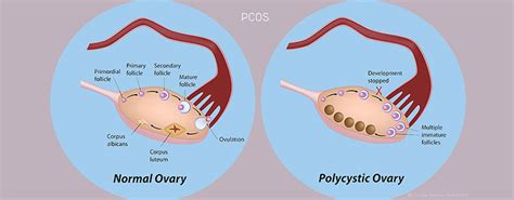 Management is important in preventing any long term health risks. PCOS & Infertility | Srushti Fertility Centre - Chennai