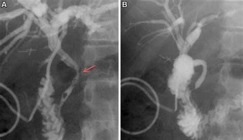 A Pre Ercp T Tube Cholangiogram Arrow Shows Cbd Stricture B Post Ercp