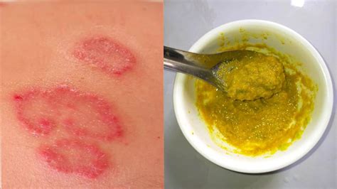How To Get Rid Of Ringworm Marks Permanently With This Mix At Home