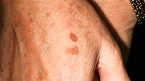 Liver Spots On Arms Images And Photos Finder