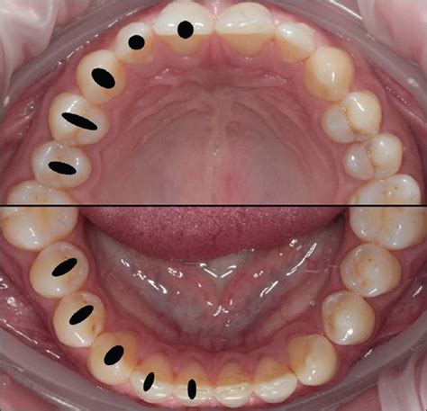 Size And Location Of Access Cavities In Maxillary And Mandibular Teeth