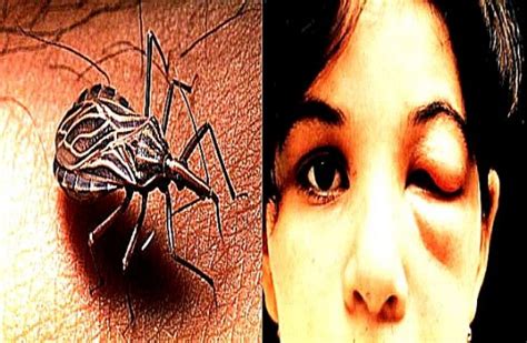Chagas Disease Pictures