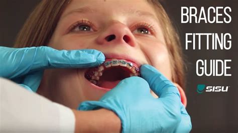 How Long Will I Need To Wear Braces Braces Explained
