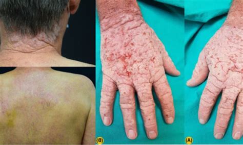 Case Of Chronic Actinic Dermatitis Gets Successfully Treated With
