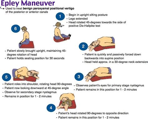 Epley Manöver Modified Epley Maneuver For Treating Right Sided Bppv