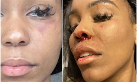 see disturbing photos of a lady beaten by her lesbian girlfriend