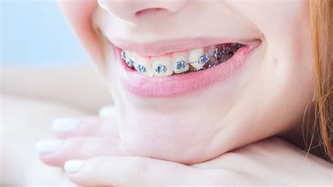 Myths About Braces And Orthodontists Centers For Dental Implants Miami
