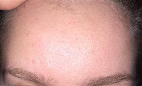 Tiny Small Bumps On Forehead Clogged Pores General Acne Discussion