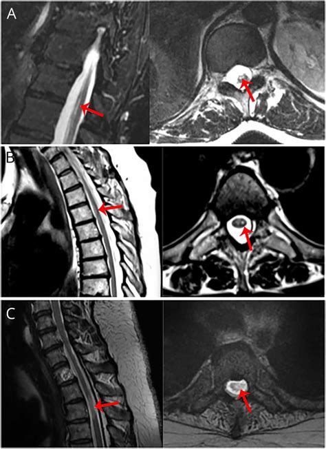 Spine Mri Sagittal And Axial Views Of Patients With Idiopathic