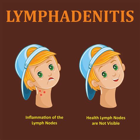 Is Your Child Having Enlarged Lymph Nodes Or Lymphadenitis Dr Ankit