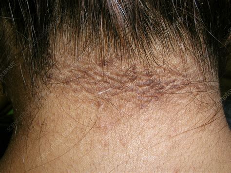 Acanthosis Nigricans Stock Image C0565305 Science Photo Library