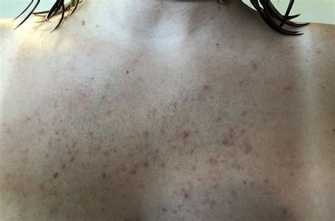 White Bumps On Chest