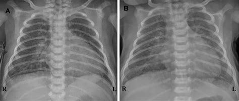 Chest X Rays Showing Cardiomegaly Hilar Congestion And Download