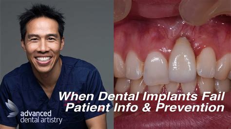 Dental Implant Failures Patient Information And Prevention Youtube