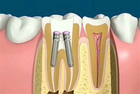 Implant Dentar Vs Pivot Dentar Si Coroana Preturi Dental Premier