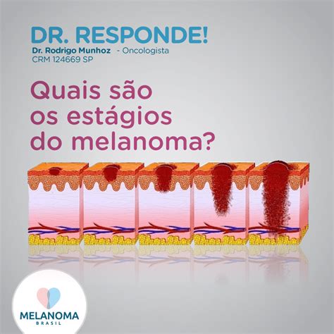 Quais São Os Estágios Do Melanoma • Instituto Melanoma Brasil