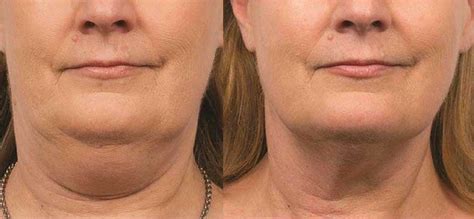 Best Double Chin Treatments 2023 Cutis Dermatology