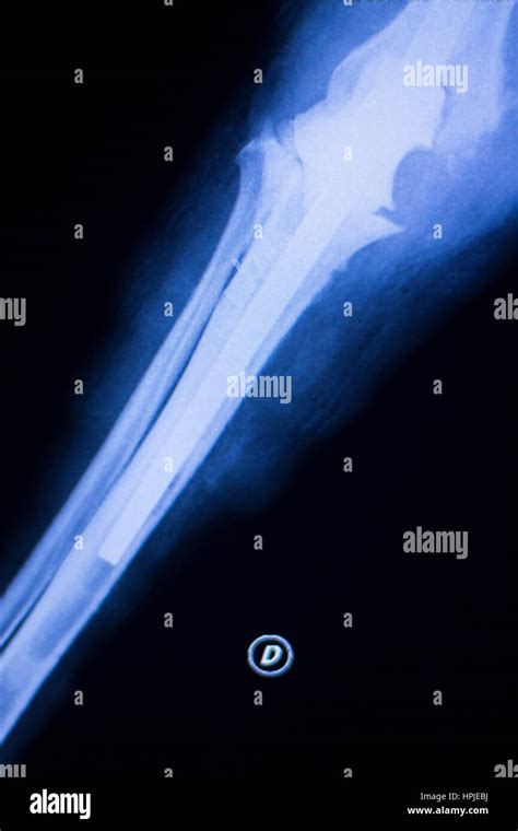 Elbow Arm Forearm Orthopedic Titanium High Resolution Stock Photography