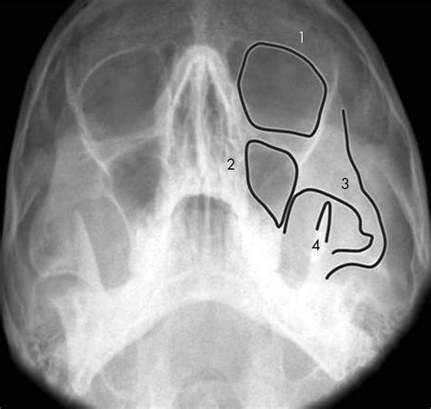 Maxillary Fracture X Rays