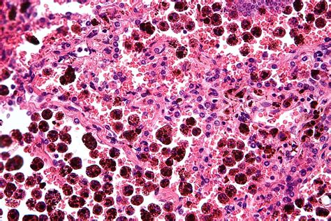 Macrophage 3 Cancer And Fucoidan