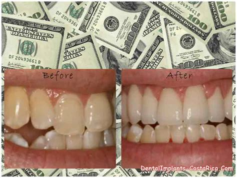 They are three times the price of composite veneers but are often not three times better looking. Cost of Dental Veneers in Costa Rica | Porcelain Veneers Prices | Dental Implants in Costa Rica