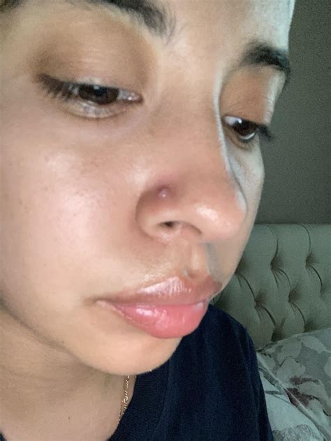 Infected Or What Is It Bump On Nose After 10 Months Piercingadvice