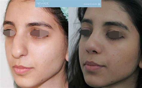 Nose Smaller Surgery Rockville Maryland Us Pics Rhinoplasty Cost