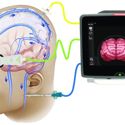 Pdf Near Infrared Spectroscopy Nirs In Traumatic Brain Injury Tbi
