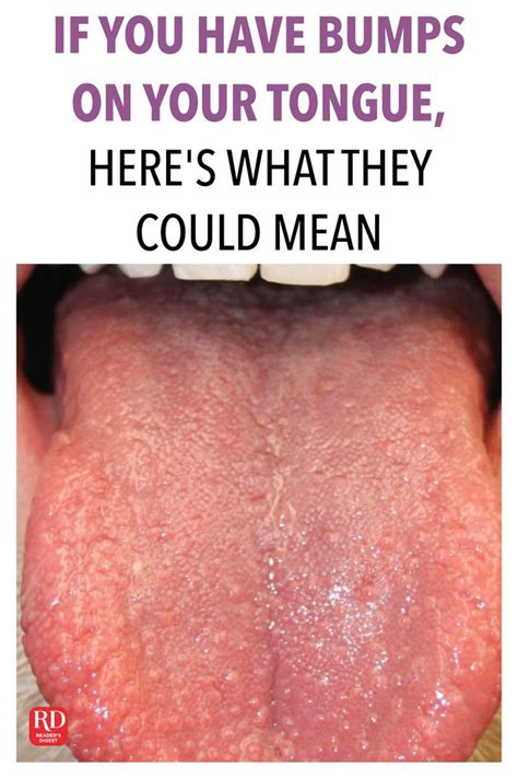 If You Have Bumps On Your Tongue Heres What They Could