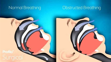 Obstructive Sleep Apnea