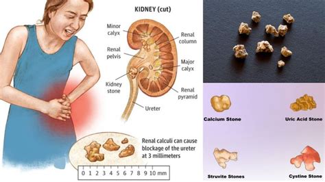 How To Identify Kidney Pain