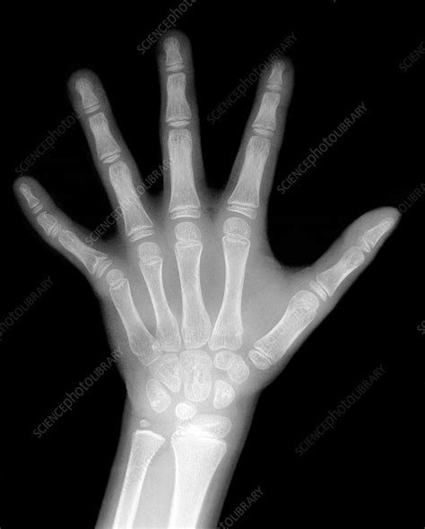 Childs Hand X Ray Stock Image P1160842 Science Photo Library