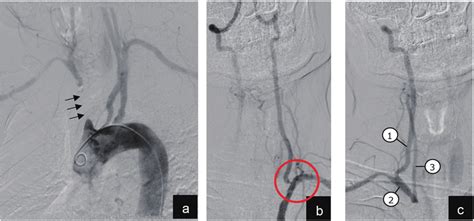 Diagnostic Angiography With Digital Subtraction Imaging A Arch Download Scientific Diagram