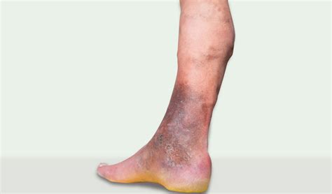 Leg Skin Discoloration Brown Spot